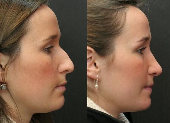 Antes e despois da rinoplastia non cirúrxica