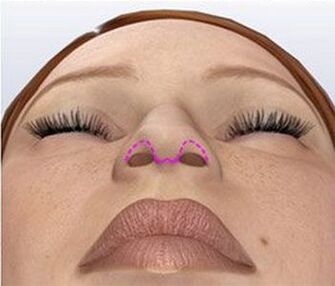 Corrección nasal