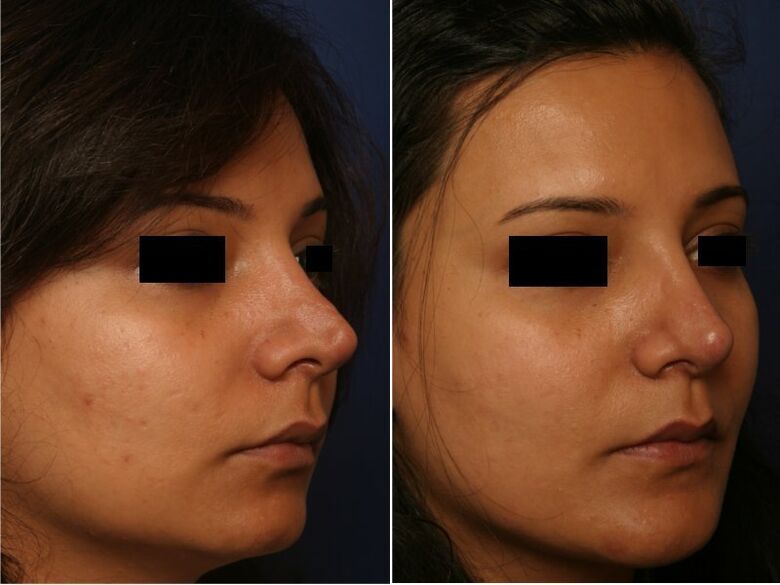 resultado da cirurxía plástica