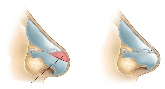 Corrección da forma do nariz