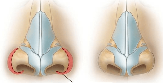 Redución da fosa nasal