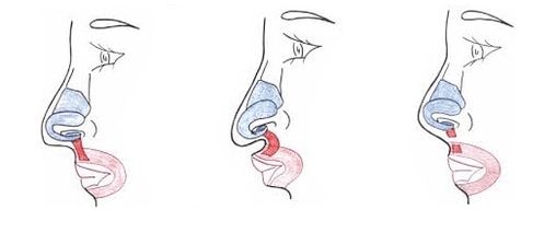 Truncamento de parte do músculo nasal