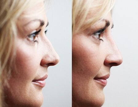 Antes e despois de rinoplastia con recheos