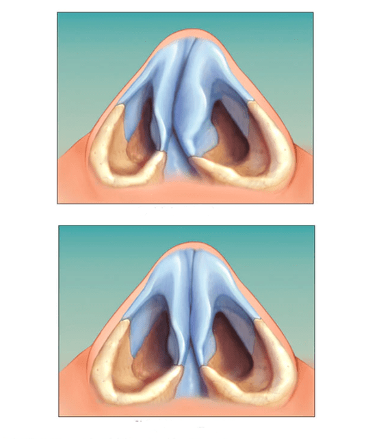 tabique nasal corrixido