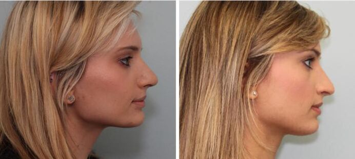 Resultados da rinoplastia antes e despois