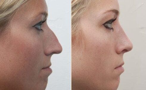 Antes e despois de rinoplastia non cirúrxica