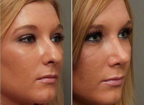 antes e despois da rinoplastia do nariz