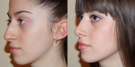 fotos antes e despois da rinoplastia nasal
