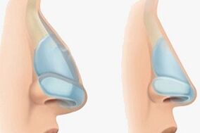 nariz antes e despois da rinoplastia