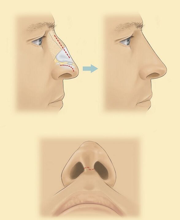 esquema para a rinoplastia do nariz