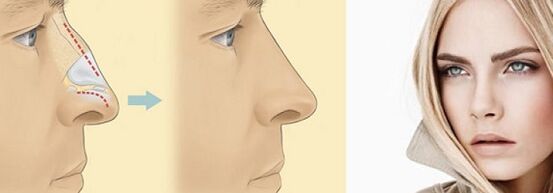 corrección da forma do nariz con rinoplastia non cirúrxica
