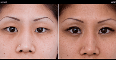 antes e despois da cirurxía ocular